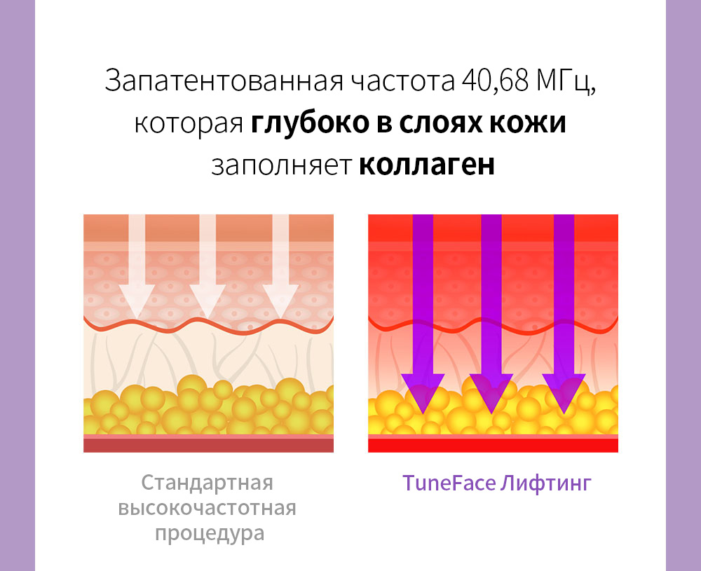 Запатентованная частота 40,68 МГц, которая глубоко в слоях кожи заполняет коллаген - Стандартная высокочастотная процедура, TuneFace Лифтинг