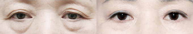 Operasi kelopak mata ganda dengan sayatan untuk usia paruh baya & Operasi buang kantong di bawah mata & Operasi isi lemak di bawah mata