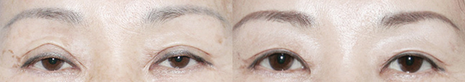 Asymmetry of the Eyelids