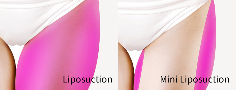 Mini Liposuction