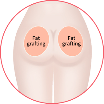 Fat grafting