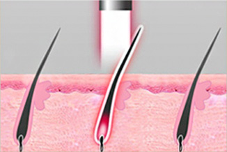 Advantage of Laser Hair Removal