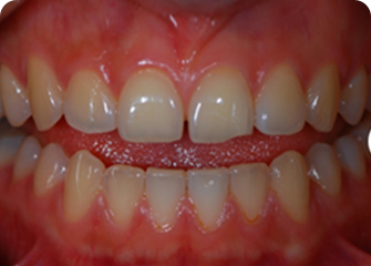 Щели и трещины зубов
