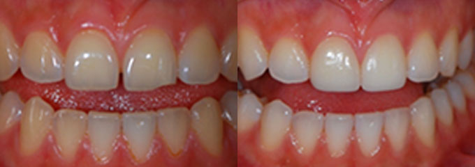 Teeth with gaps / cracks