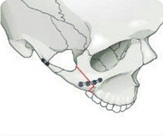 Memasang tulang untuk posisi yang aman