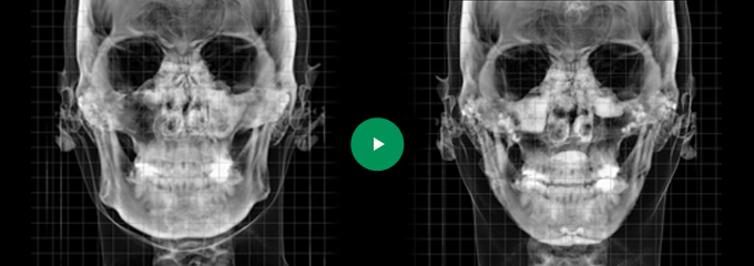 Efek-efek dari Kontur Wajah Lengkap CT01