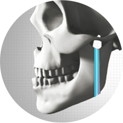 IVRO (Pemotongan Vertikal Tulang Rahang Bawah Dalam Mulut)