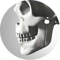 IVRO (Pemotongan Vertikal Tulang Rahang Bawah Dalam Mulut)