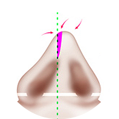 Nasal bone fracture Method