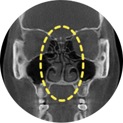 Deviated septal cartilage