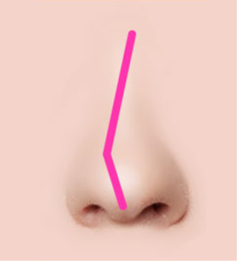 Различные виды искривления носовой перегородки