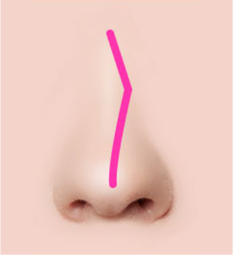 Các trường hợp khác nhau của lệch vách ngăn mũi