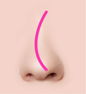 Các trường hợp khác nhau của lệch vách ngăn mũi