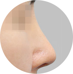 Deformasi ujung hidung karena implan