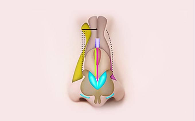 Osteotomy dari berbagai arah dan metode untuk mengurangi batang hidung