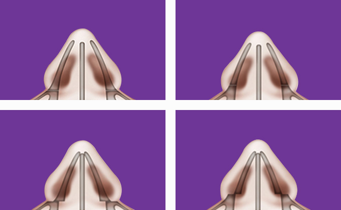 缩减鼻骨宽度的多种骨方向与手术方法