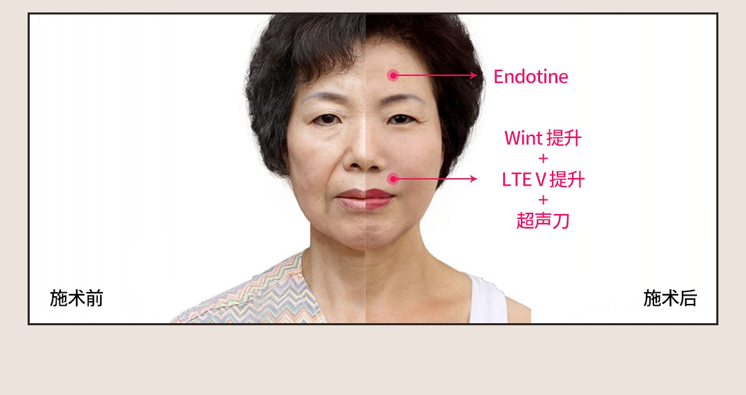 01.施术前 / 施术后 -Endotine -Wint 提升 + LTE V 提升 + 超声刀