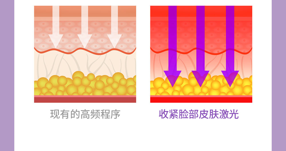 现有的高频程序 / 收紧脸部皮肤激光