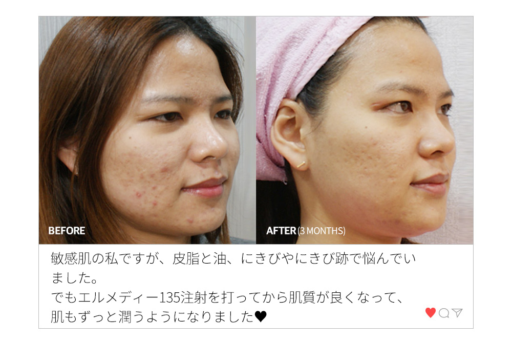 BEFORE & AFTER(3 MONTHS) 敏感肌の私ですが、皮脂と油、にきびやにきび跡で悩んでいました。でもエルメディー135注射を打ってから肌質が良くなって、肌もずっと潤うようになりました♥