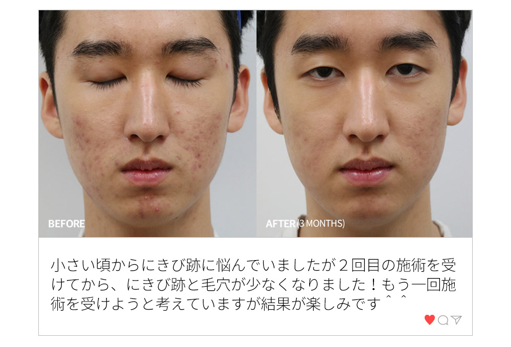 BEFORE & AFTER(3 MONTHS) 小さい頃からにきび跡に悩んでいましたが２回目の施術を受けてから、にきび跡と毛穴が少なくなりました！もう一回施術を受けようと考えていますが結果が楽しみです＾＾