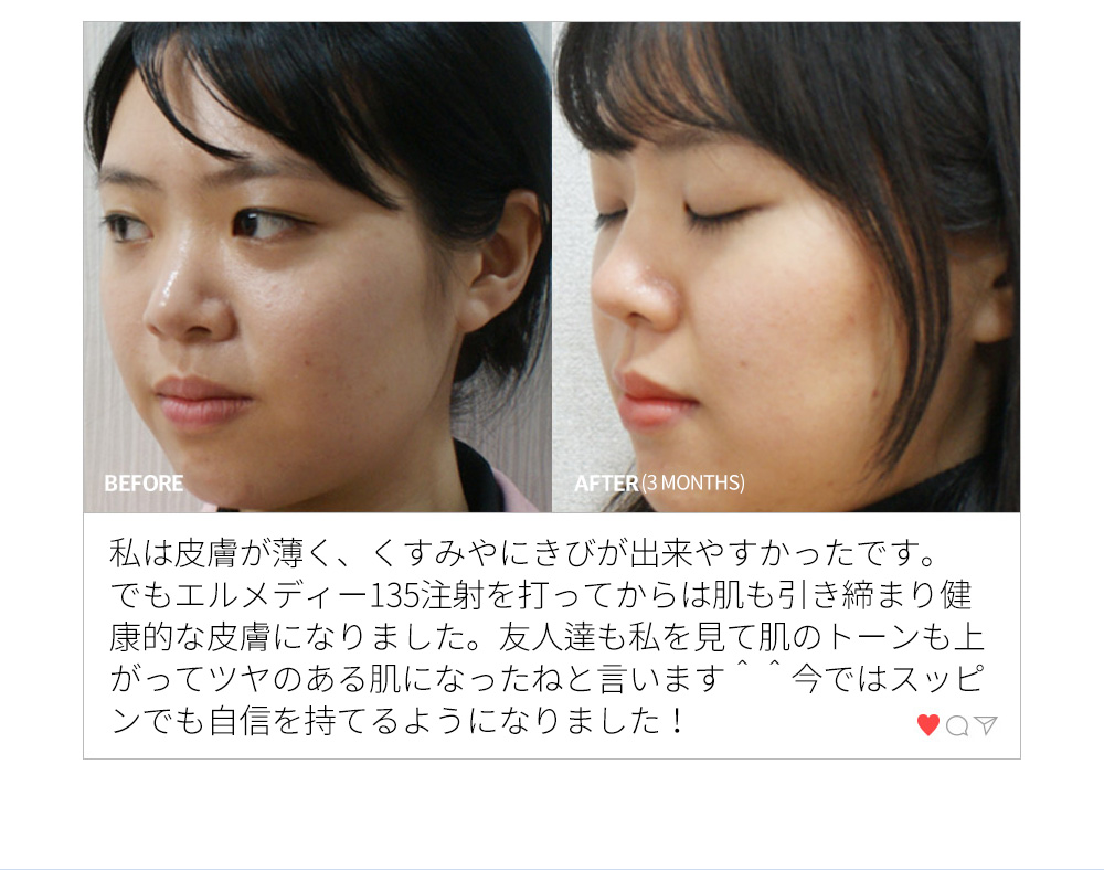 BEFORE & AFTER(3 MONTHS) 私は皮膚が薄く、くすみやにきびが出来やすかったです。でもエルメディー135注射を打ってからは肌も引き締まり健康的な皮膚になりました。友人達も私を見て肌のトーンも上がってツヤのある肌になったねと言います＾＾今ではスッピンでも自信を持てるようになりました！