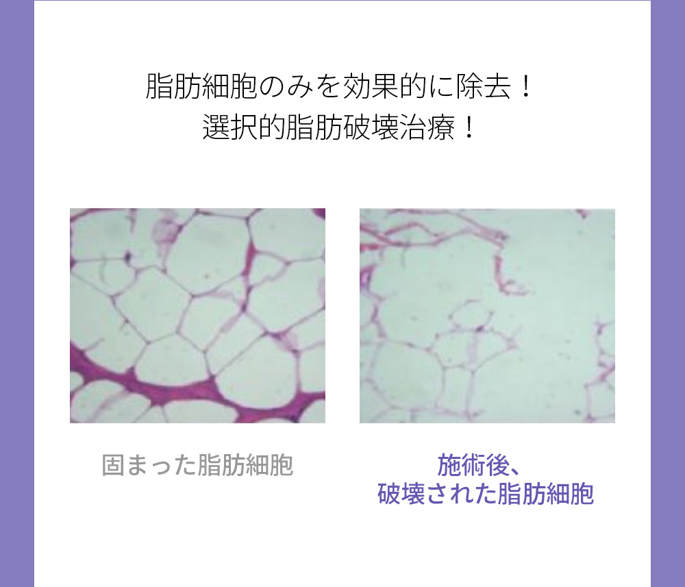 脂肪細胞のみを効果的に除去！選択的脂肪破壊治療！, 固まった脂肪細胞/施術後、破壊された脂肪細胞