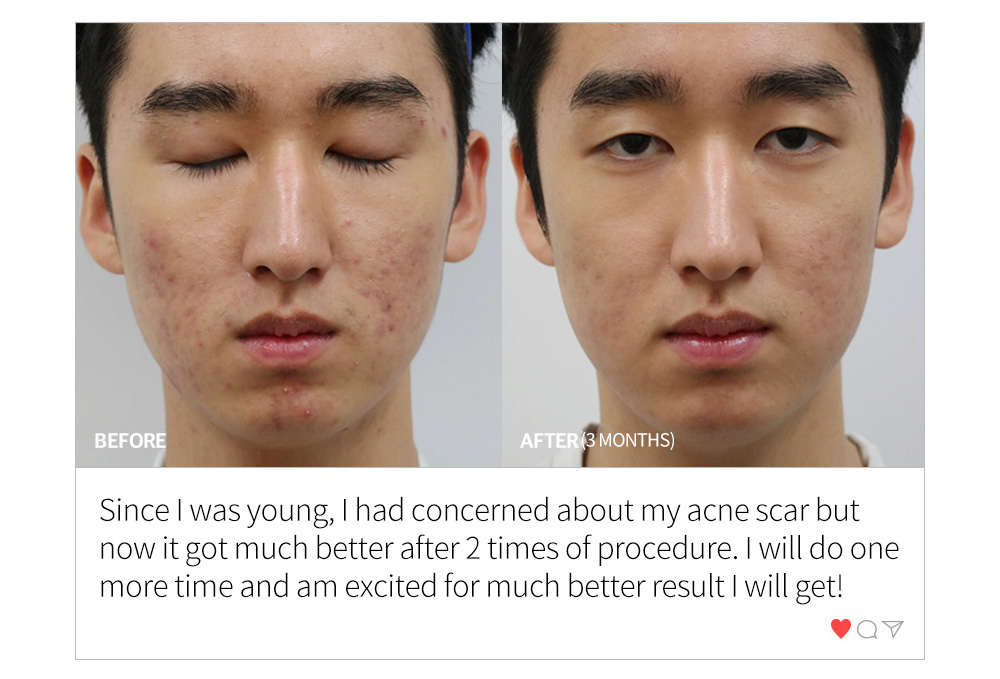 BEFORE & AFTER (3 MONTHS) , Since I was young, I had concerned about my acne scar but now it got much better after 2 times of procedure. I will do one more time and am excited for much better result I will get!