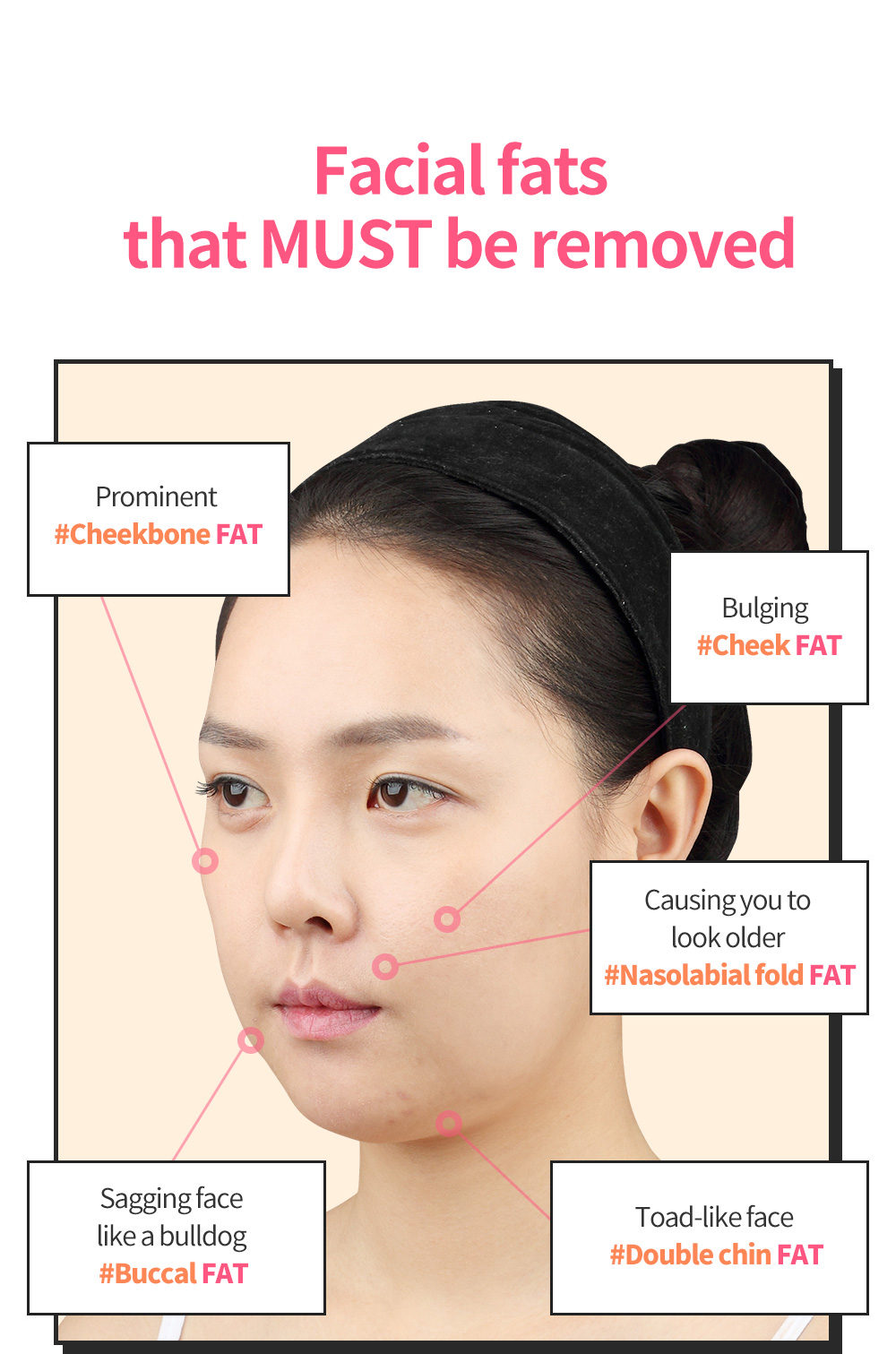 Facial fats that MUST be removed, Prominent #Cheekbone FAT, Sagging face like a bulldog #Buccal FAT, Bulging  #Cheek FAT, Causing you to look older #Nasolabial fold FAT, Toad-like face #Double chin FAT
