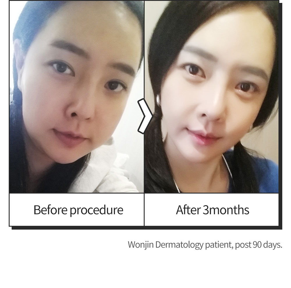 Before procedure > After 3months Wonjin Dermatology patient, post 90 days.