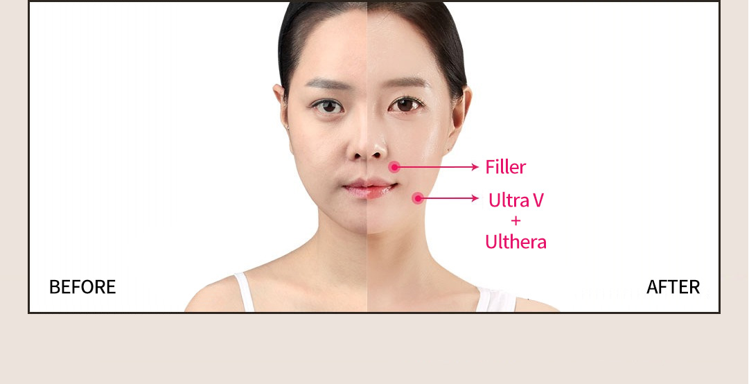 BEFORE / AFTER Filler + Ultra V + Ulthera