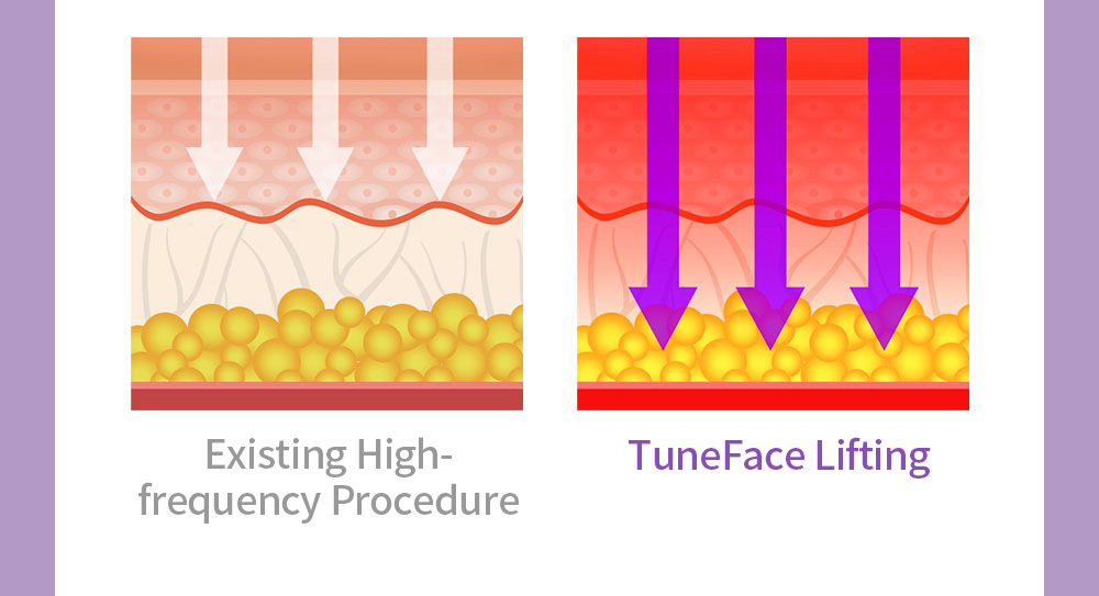Existing High-frequency Procedure, TuneFace Lifting