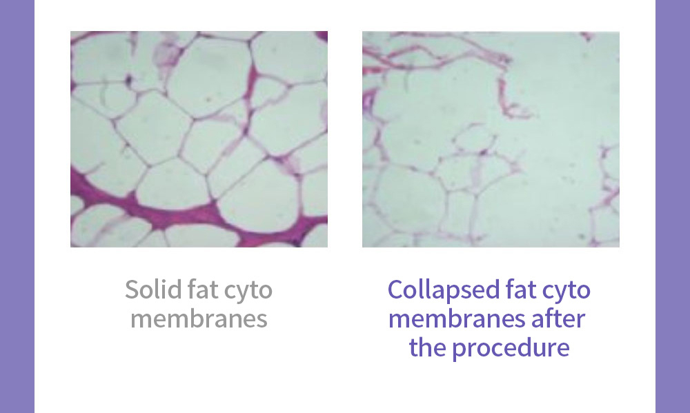 Solid fat cyto membranes, Collapsed fat cyto membranes after the procedure