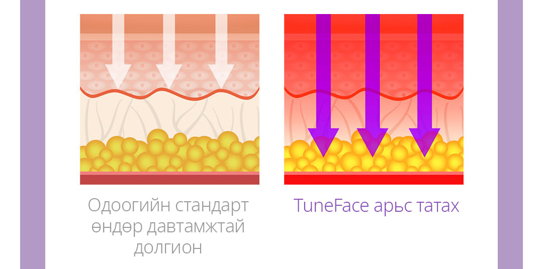 Одоогийн стандарт өндөр давтамжтай долгион / TuneFace арьс татах