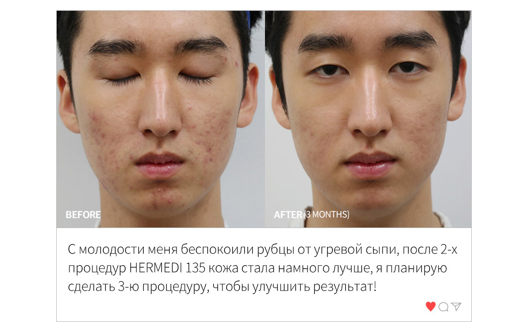 BEFORE & AFTER (3 MONTHS) , С молодости меня беспокоили рубцы от угревой сыпи, после 2-х процедур HERMEDI 135 кожа стала намного лучше, я планирую сделать 3-ю процедуру, чтобы улучшить результат!