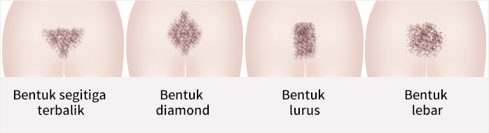 Bentuk segitiga terbalik, Bentuk berlian, Bentuk Linier, Bentuk Menyebar