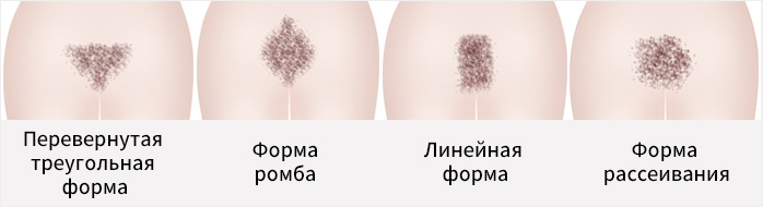 Перевернутая треугольная форма, Форма ромба, Линейная форма, Форма рассеивания