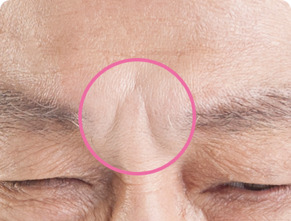 Glabella wrinkle