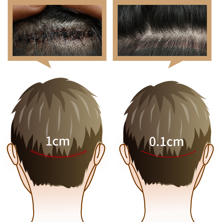 Sesudah Operasi Transplantasi Rambut Sayatan