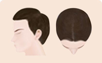 男士脱发的过程阶段1