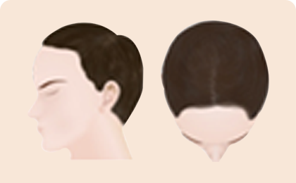 Tiến trình rụng tóc của nam giới 2