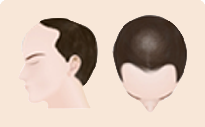 Tiến trình rụng tóc của nam giới 3