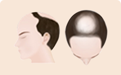 Tiến trình rụng tóc của nam giới 4