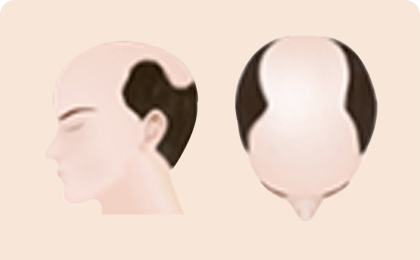 男士脱发的过程阶段5