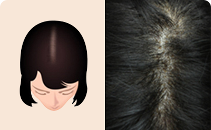 Tiến trình rụng tóc của nữ giới 1