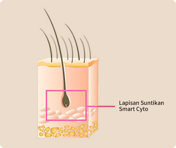 Lapisan Suntikan Smart Stem