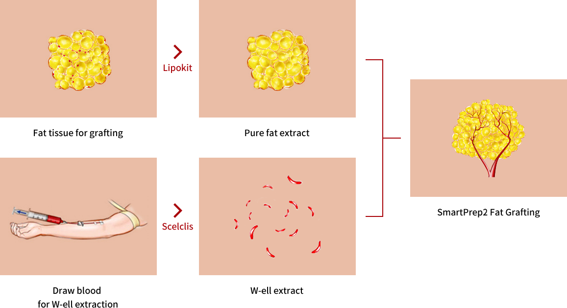 Process of W-ell Fat Grafting