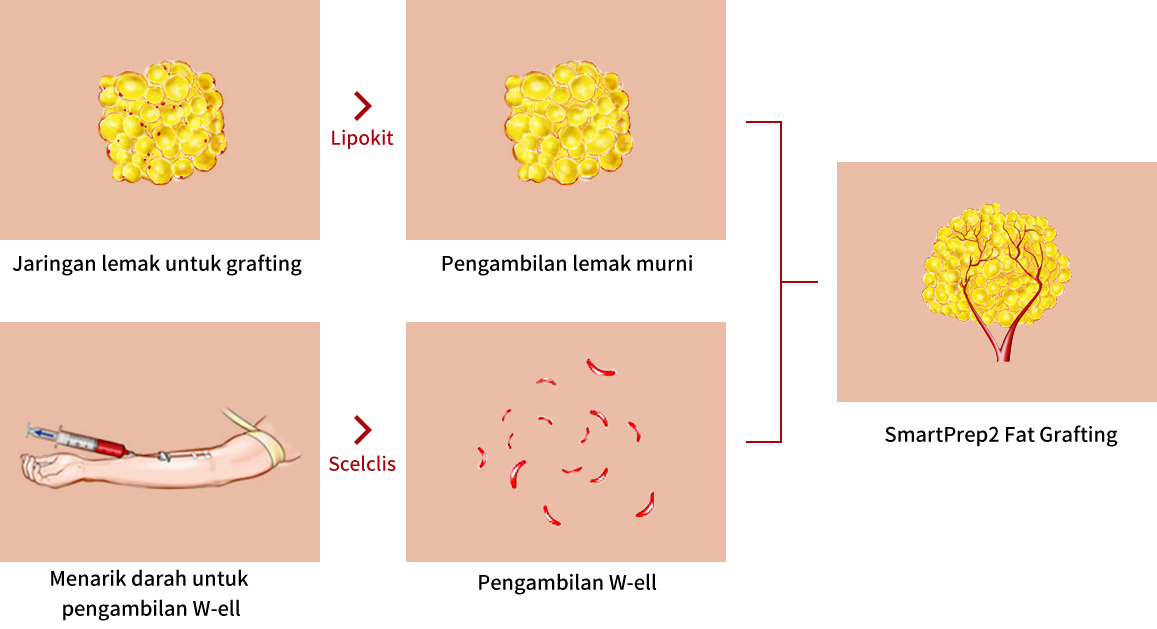 Proses Fat Grafting W-ell