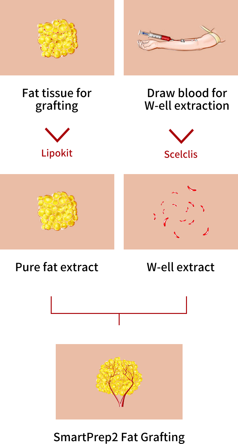 Process of W-ell Fat Grafting