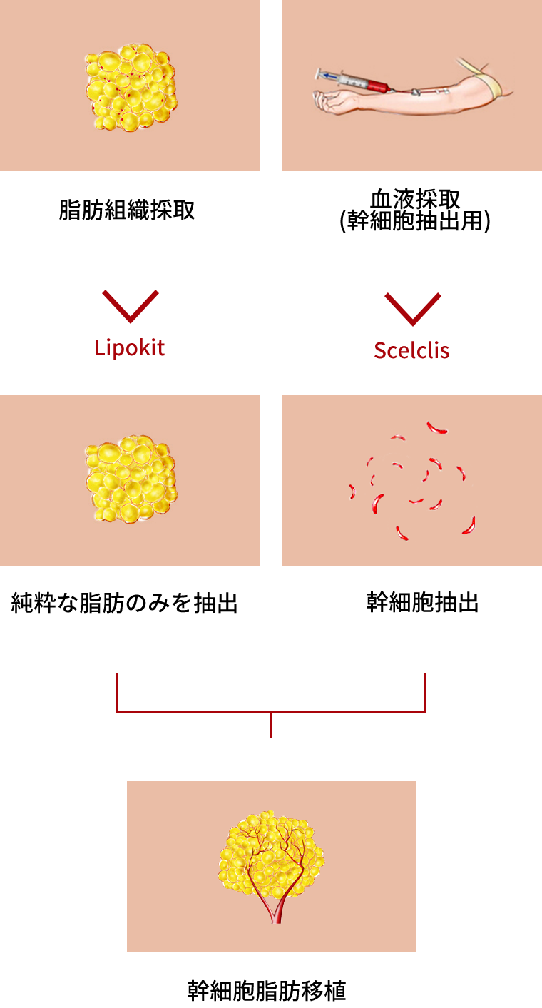 Process of W-ell Fat Grafting