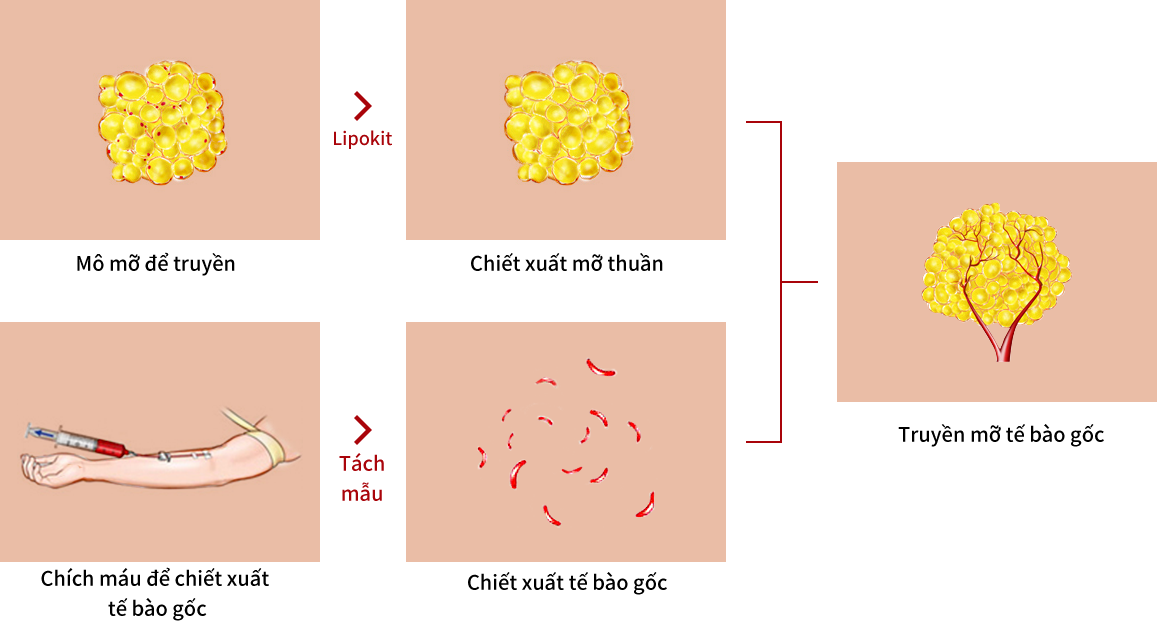 Quá trình phẫu thuật truyền mỡ tế bào gốc